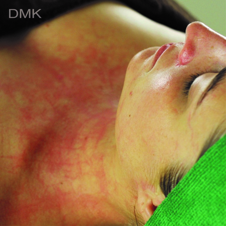 DMK Treatment - Photo 002